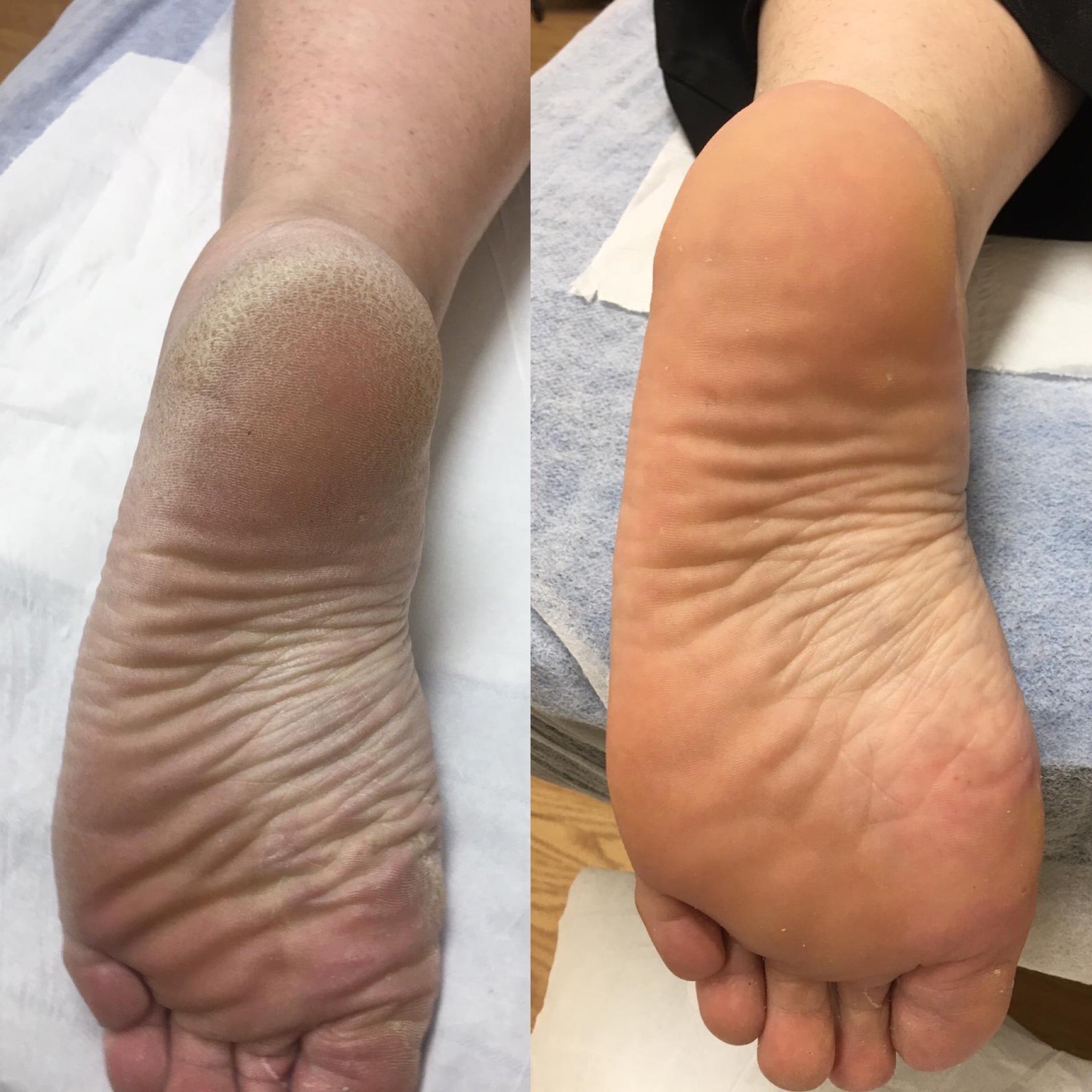 Elektrisk Fothøvel - AVABeauty.no